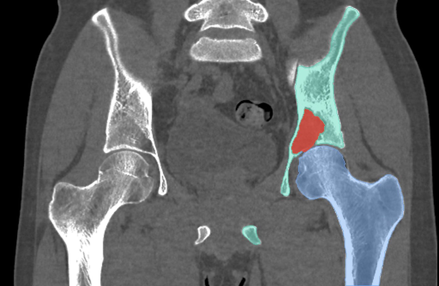 The same CT with AI segmentation: pelvis in teal, femur in blue and the tumor in red