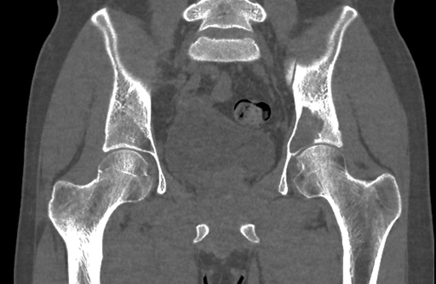 De-identified CT of a pelvic bone tumor case, coronal view