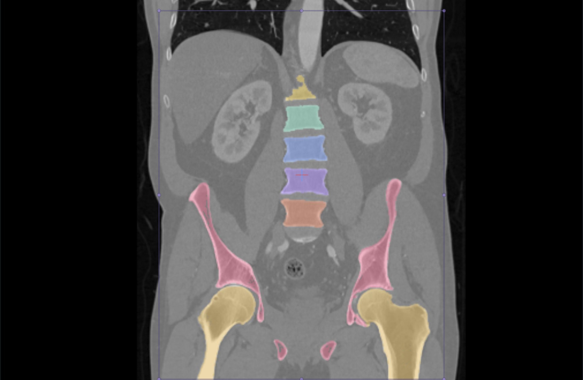 The same CT with AI segmentation: L1 to L5, pelvis, sacrum and femurs in colour